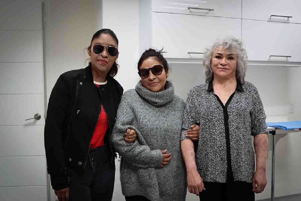 Retomar la vida tras un ataque con ácido, el largo y difícil proceso para la recuperación