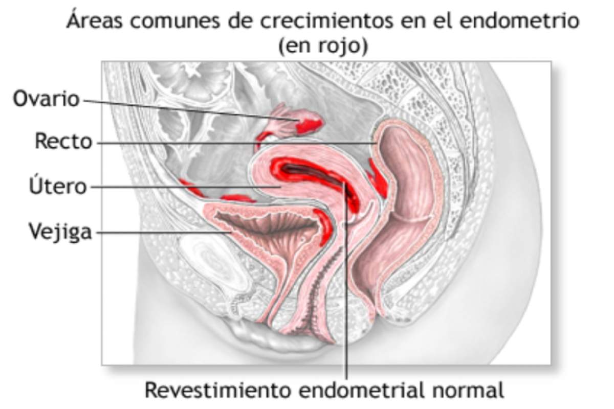 Endometriosis