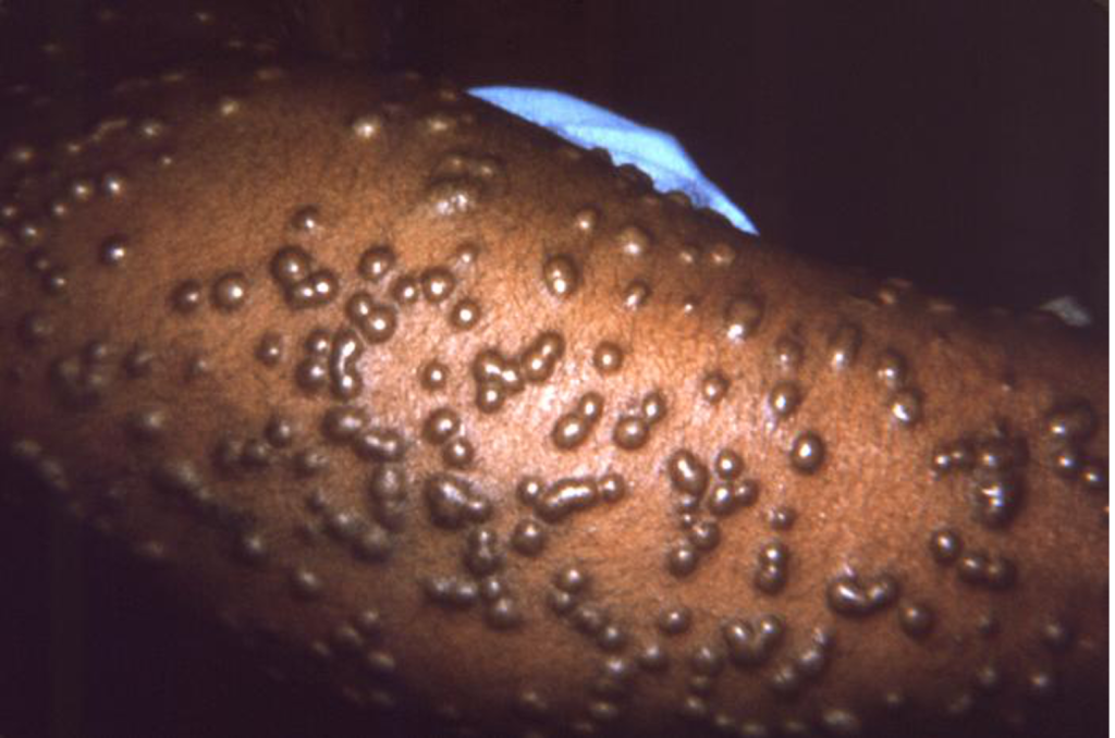 Se muestra el brazo derecho de una persona que contrajo viruela, la cual se manifestó con el característico sarpullido maculopapular, que en el momento de la fotografía estaba en su etapa pustulosa tardía (CDC/ Dr. John Noble, Jr., 1968).