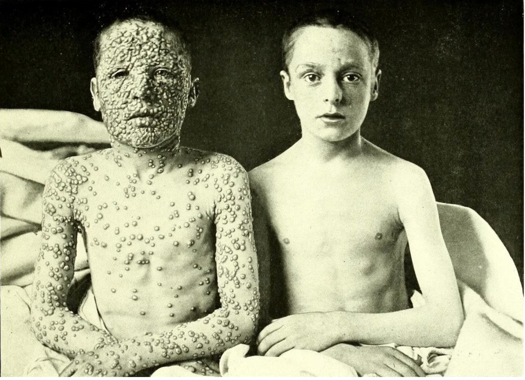 Dos niños con viruela, fotografiados por el Dr. Allan Warner, Hospital de Aislamiento en Leicester, Reino Unido. Extraído del Atlas of Clinical Medicine, Surgery, and Pathology de 1901.