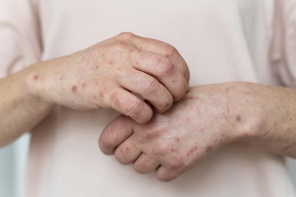En las últimas semanas se registró un brote de sarampión en la región de las Américas. Foto: Freepik