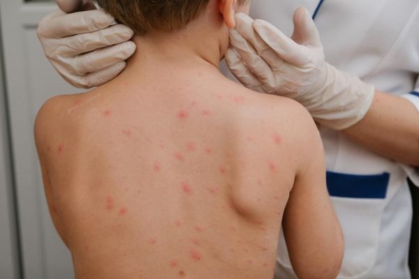 Heridas en la piel provocadas por el sarampión