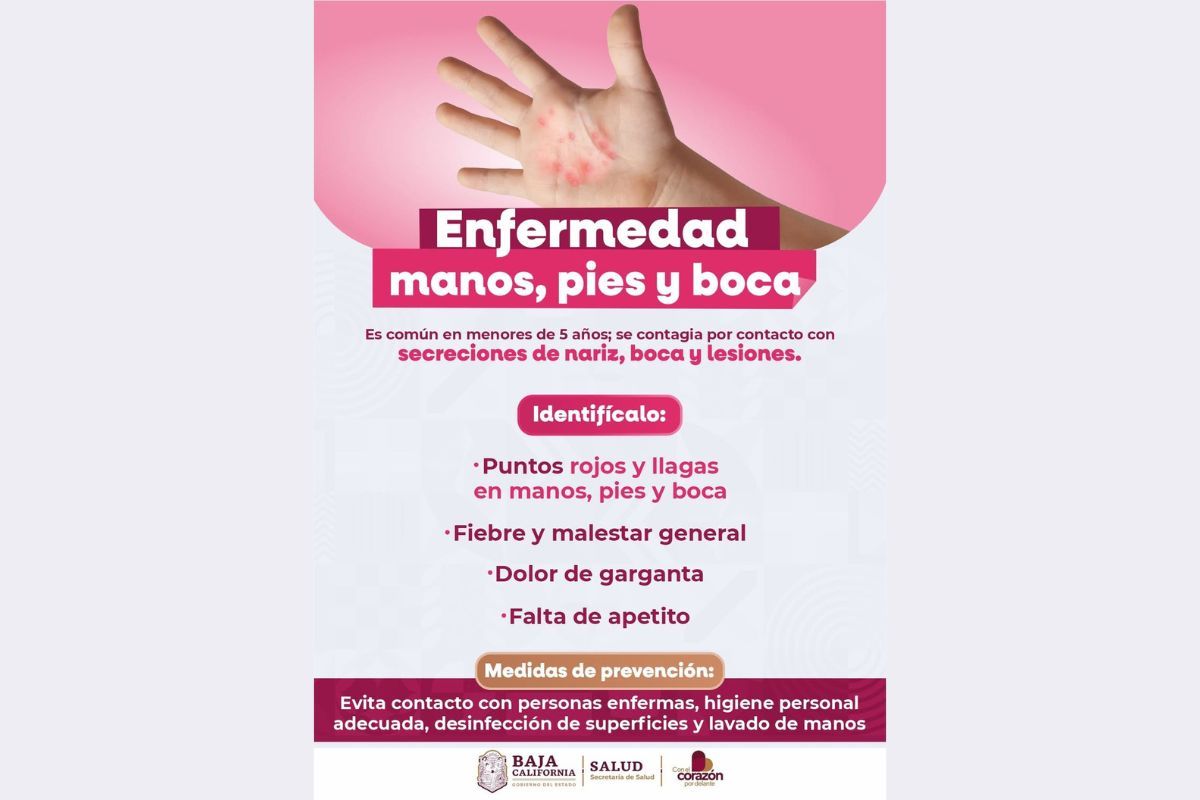 Esta enfermedad, causada por el virus Coxsackie, es muy común en menores de diez años. Aquí te explicamos qué es, cómo identificarla, y las recomendaciones de los especialistas. 